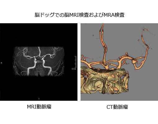 脳MRI検査およびMRA検査診断画像